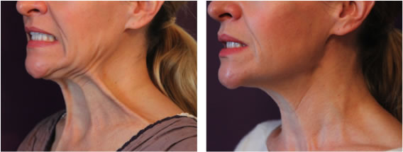 Ageing Neck correction at Perfect Style Clinic